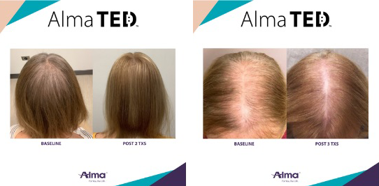 Alma-TED-BxA
