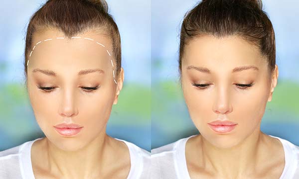 Female Before & After hair Transplant