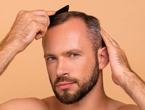 Types of Hair Loss